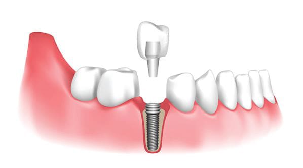 dental-implants Graphic of a dental implant