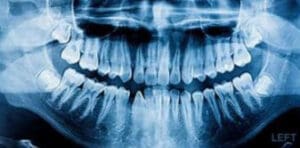 Dental X-Rays