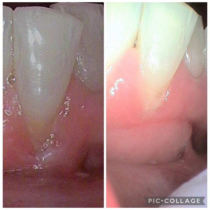 Free Gingival Graft