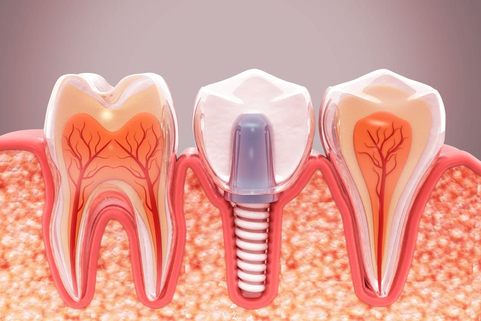 3D render of a dental implant.