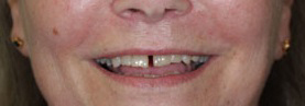 Before Before