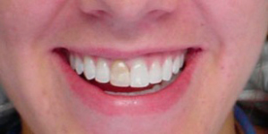 Before Before