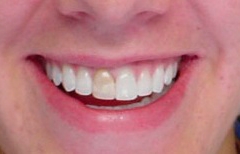 Before Before