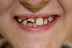 Before Before